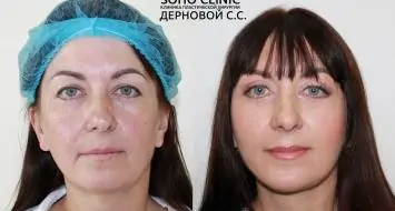 Фото до и после