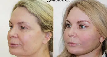 Фото до и после