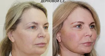 Фото до и после