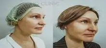 Фото до и после