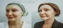 Фото до и после