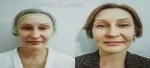 Фото до и после